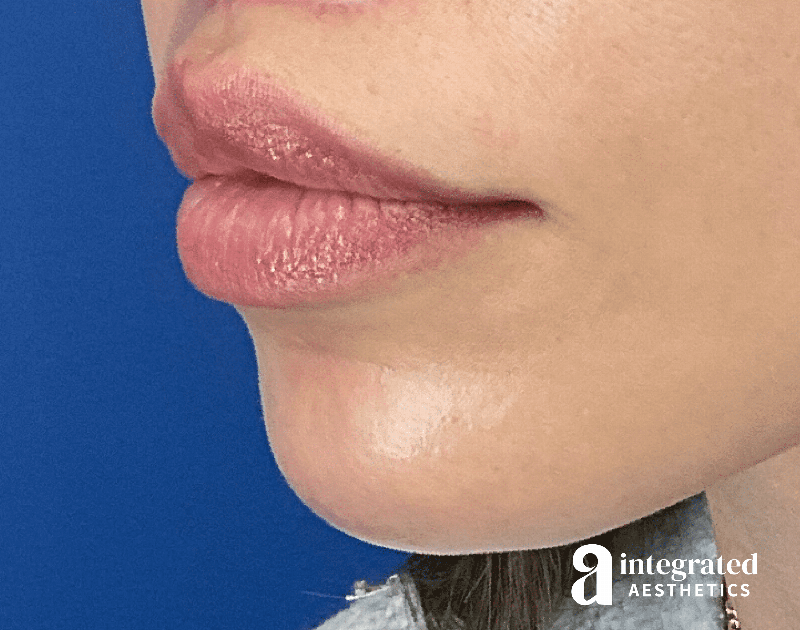 Lip Lift Before & After Gallery - Patient 175677 - Image 6