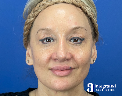 Chemical Peel Before & After Gallery - Patient 302135 - Image 1