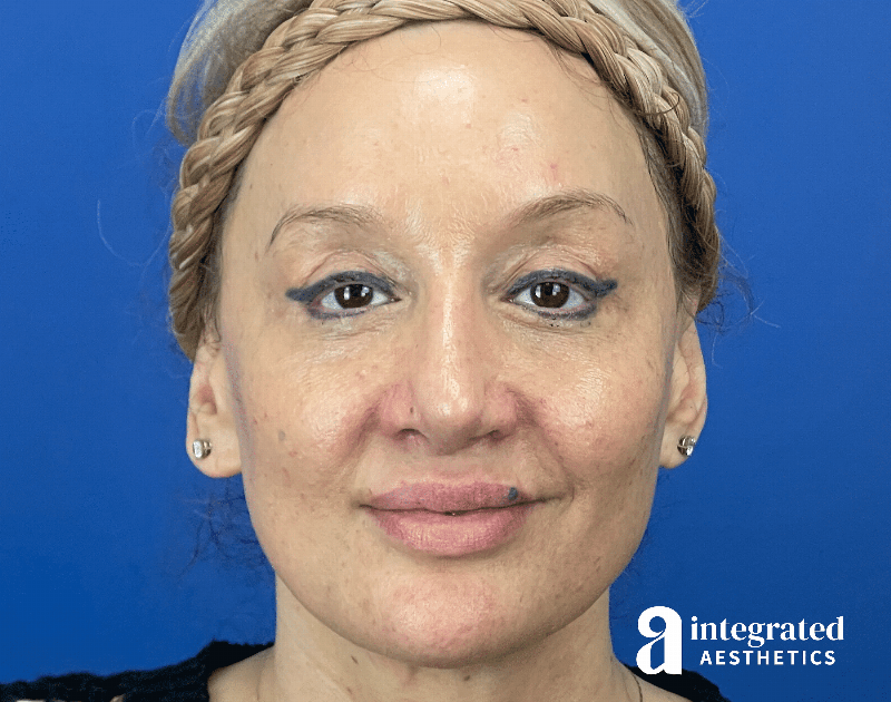 Chemical Peel Before & After Gallery - Patient 302135 - Image 1