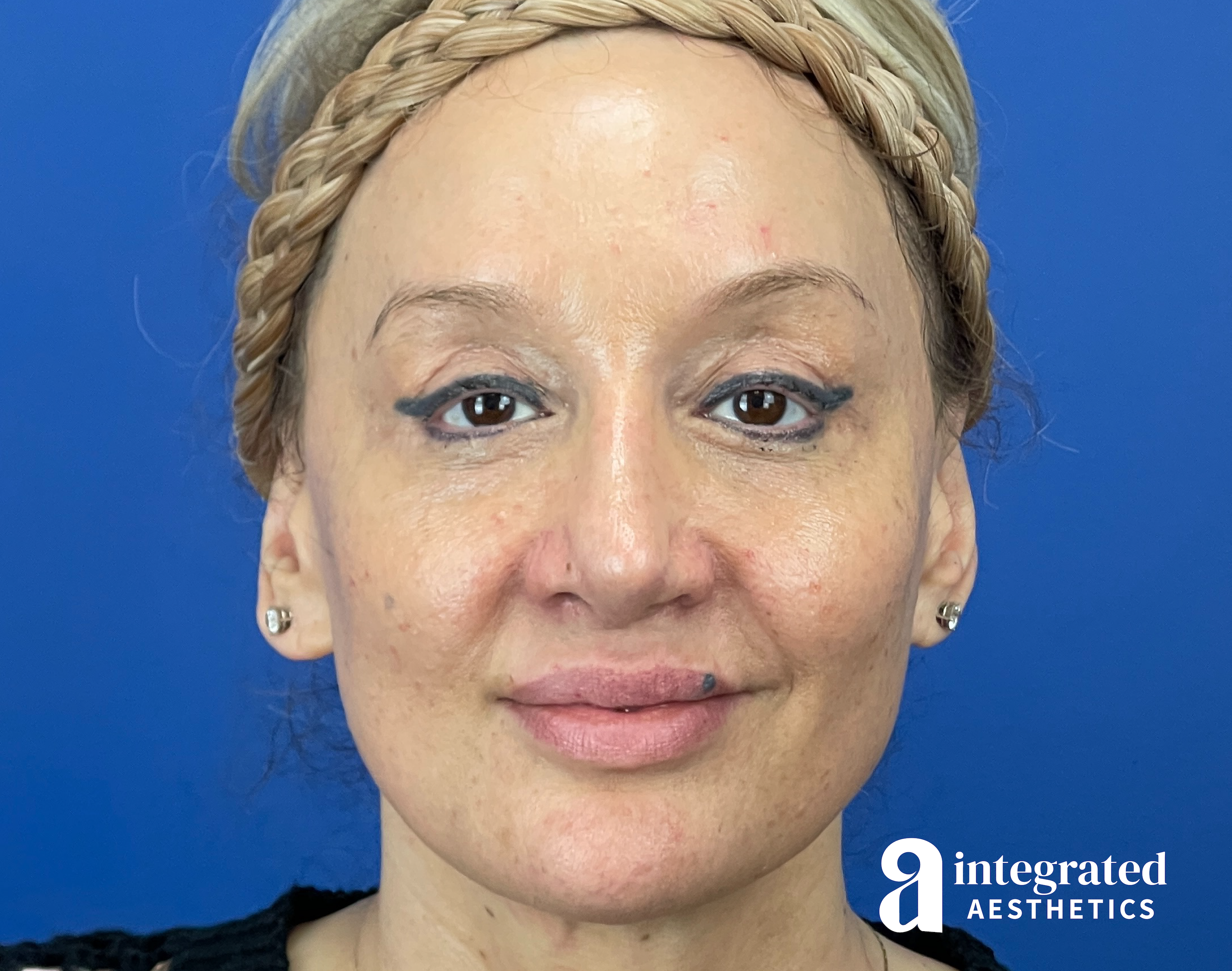 Chemical Peel Before & After Gallery - Patient 302135 - Image 1