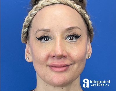 Chemical Peel Before & After Gallery - Patient 302135 - Image 2