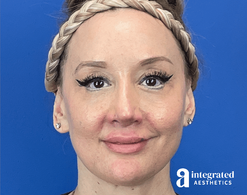 Chemical Peel Before & After Gallery - Patient 302135 - Image 2