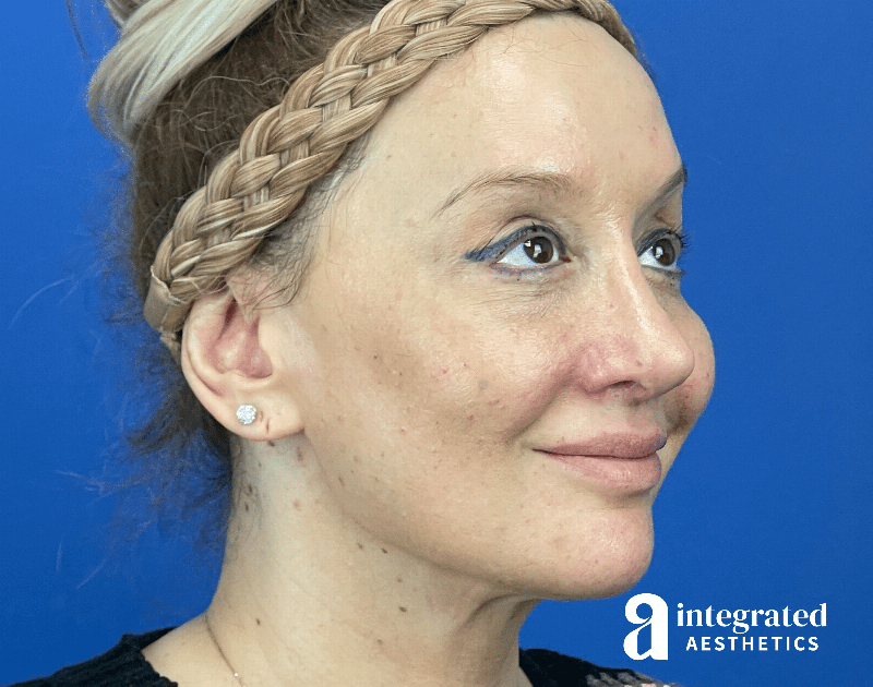 Chemical Peel Before & After Gallery - Patient 302135 - Image 3