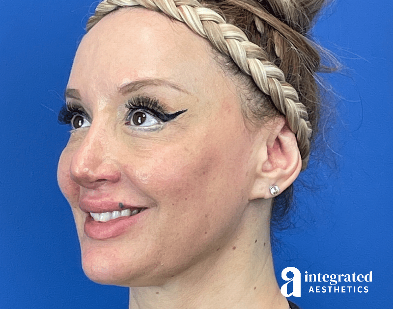 Chemical Peel Before & After Gallery - Patient 302135 - Image 6