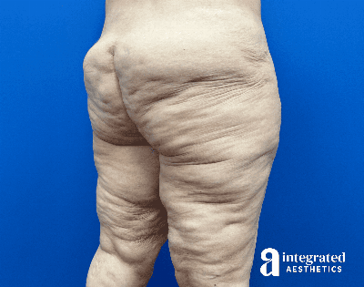 Butt Lift Before & After Gallery - Patient 176284 - Image 1