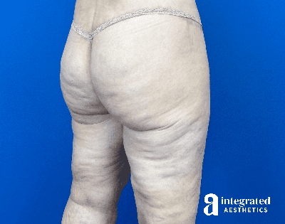 Butt Lift Before & After Gallery - Patient 176284 - Image 2