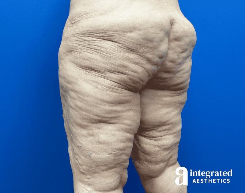 Thigh Lift Before & After Gallery - Patient 518319 - Image 3