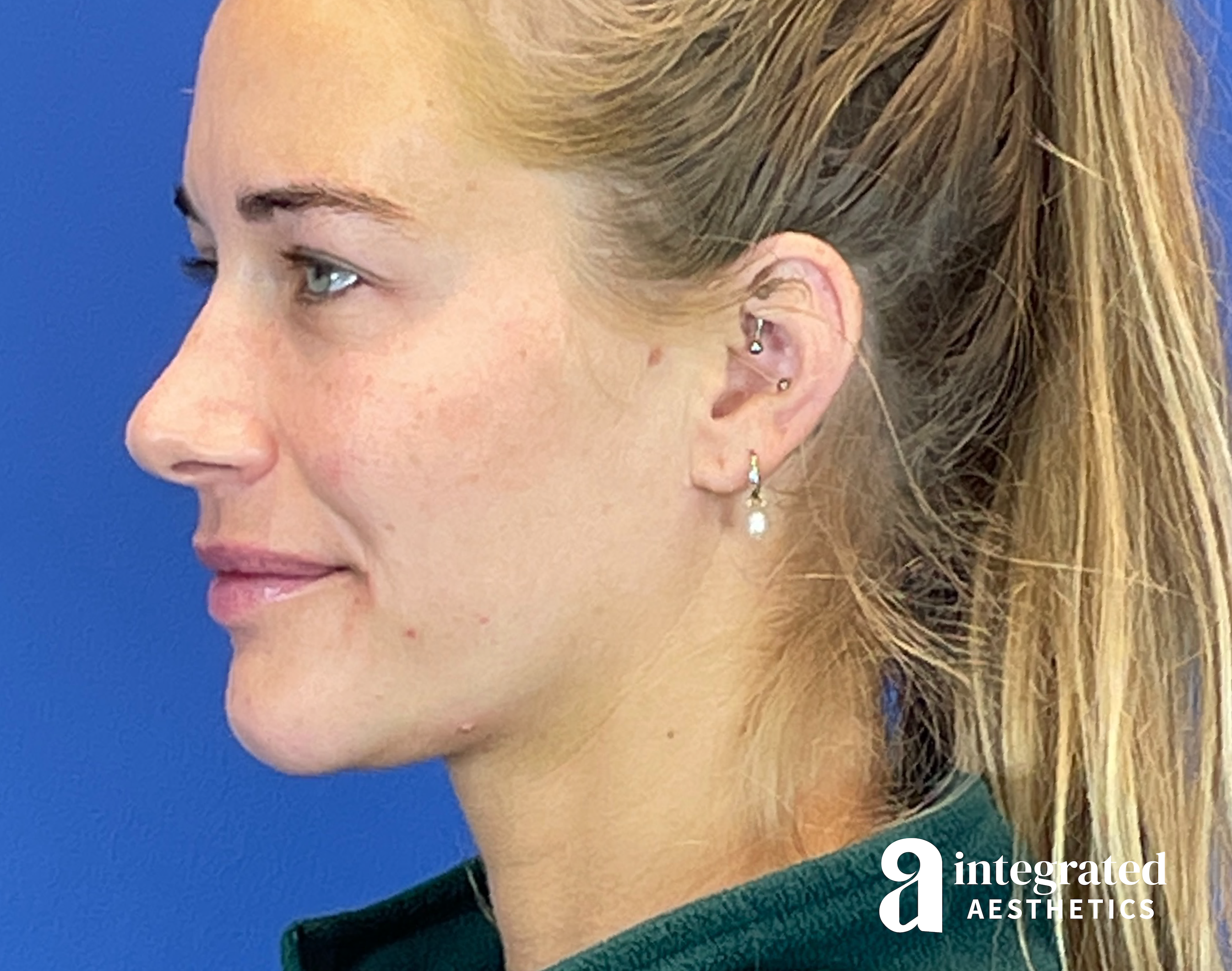 Kybella Before & After Gallery - Patient 287600 - Image 2