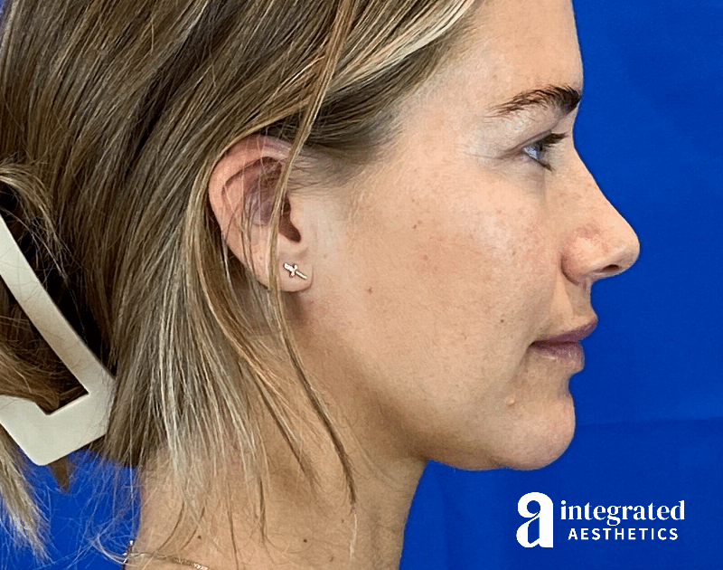 Kybella Before & After Gallery - Patient 287600 - Image 3