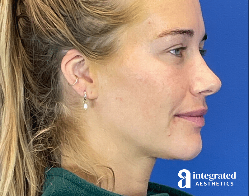 Kybella Before & After Gallery - Patient 287600 - Image 4