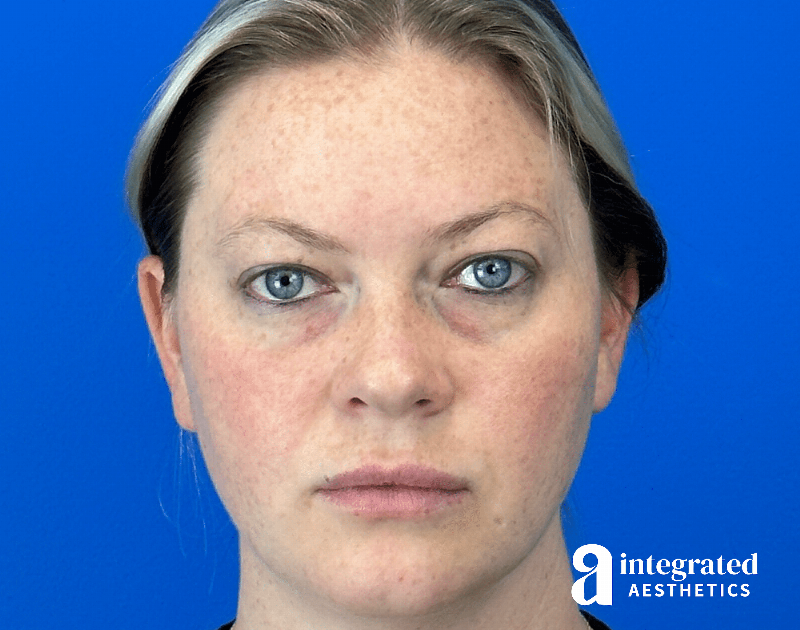 Chemical Peel Before & After Gallery - Patient 101459 - Image 1