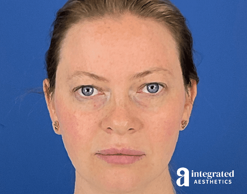 Chemical Peel Before & After Gallery - Patient 101459 - Image 2