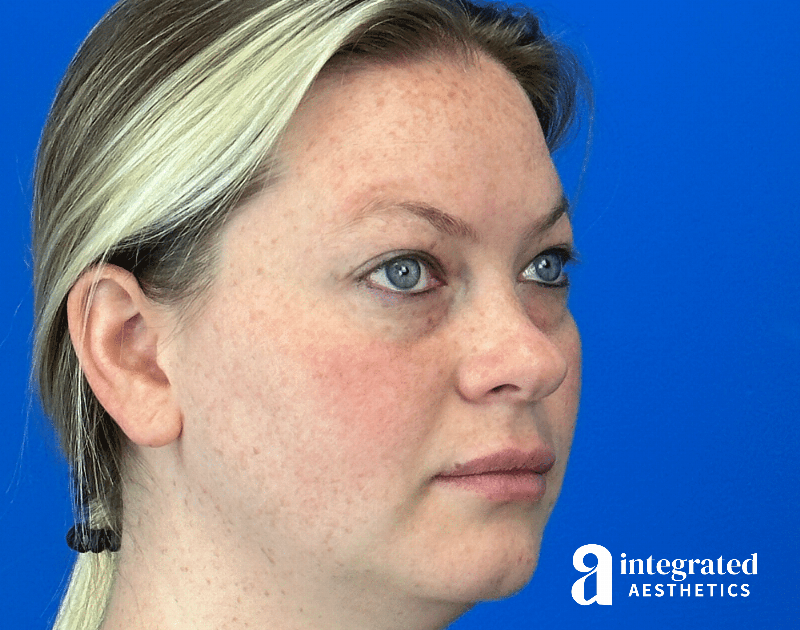 Chemical Peel Before & After Gallery - Patient 101459 - Image 3