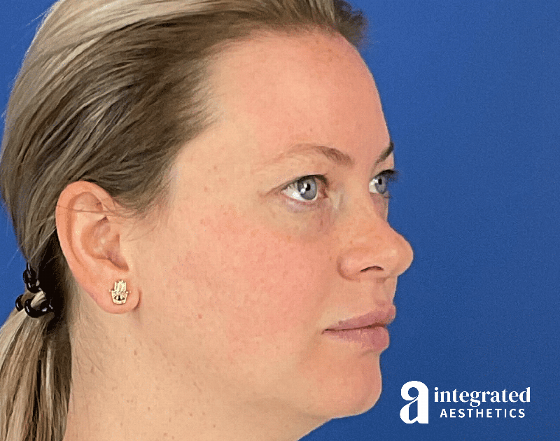 Chemical Peel Before & After Gallery - Patient 101459 - Image 4