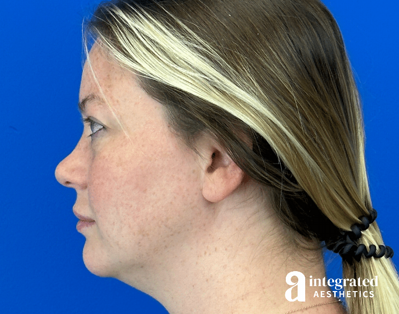 Chemical Peel Before & After Gallery - Patient 101459 - Image 5