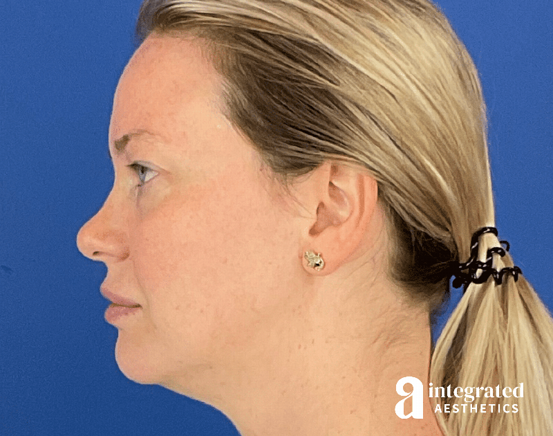 Chemical Peel Before & After Gallery - Patient 101459 - Image 6