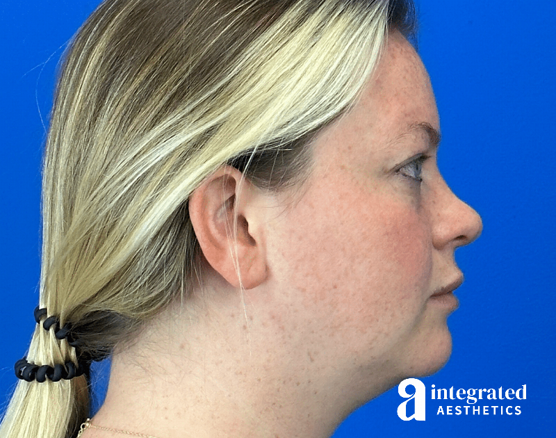 Chemical Peel Before & After Gallery - Patient 101459 - Image 7