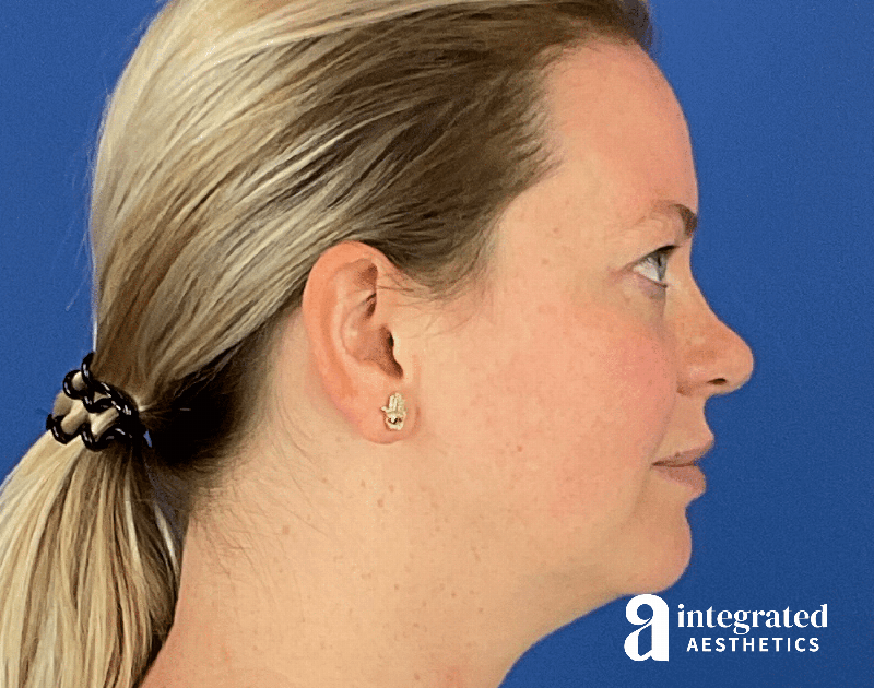 Chemical Peel Before & After Gallery - Patient 101459 - Image 8