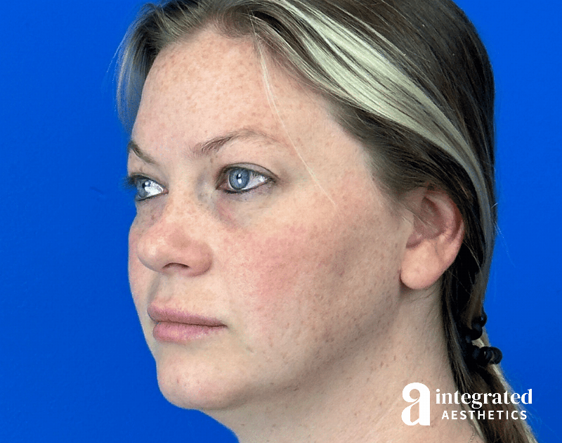 Chemical Peel Before & After Gallery - Patient 101459 - Image 9