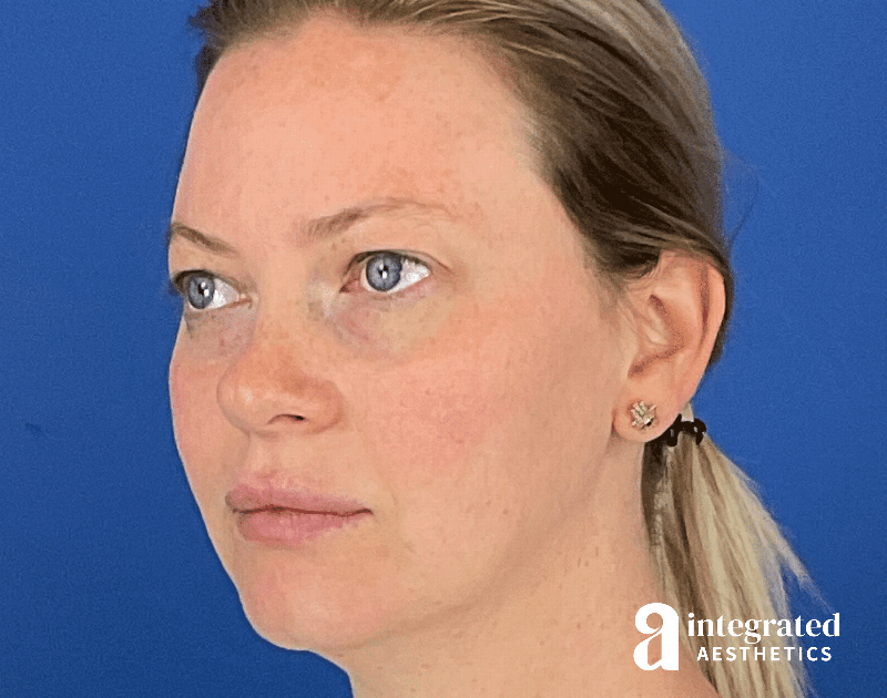 Chemical Peel Before & After Gallery - Patient 101459 - Image 10