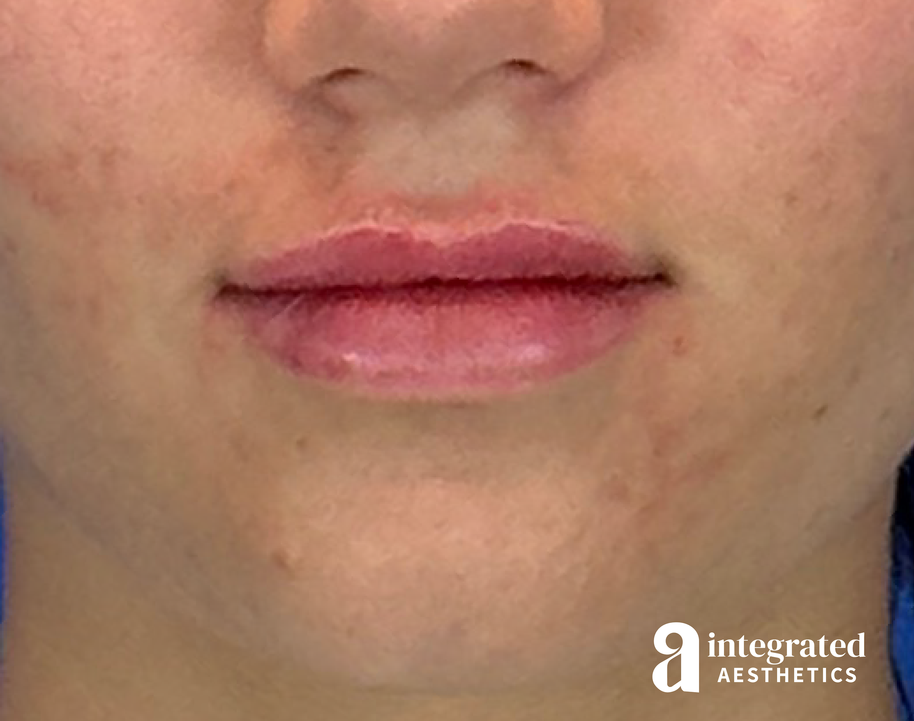 Lip Filler Before & After Gallery - Patient 342128 - Image 1