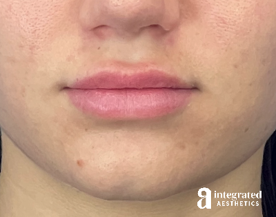 Lip Filler Before & After Gallery - Patient 342128 - Image 2