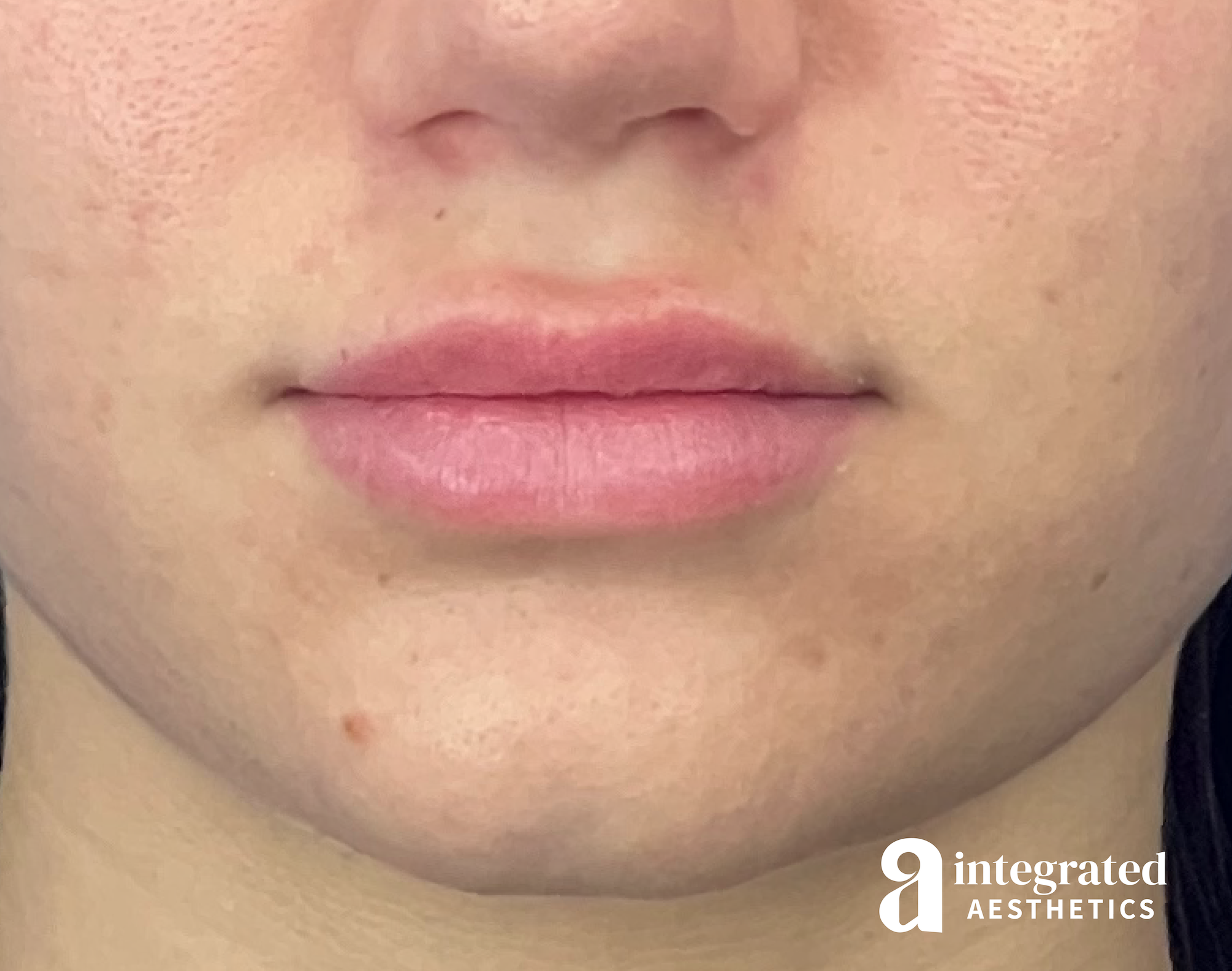 Lip Filler Before & After Gallery - Patient 342128 - Image 2