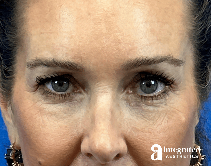 Blepharoplasty Before & After Gallery - Patient 301217 - Image 1