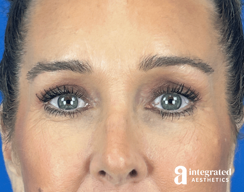 Blepharoplasty Before & After Gallery - Patient 301217 - Image 2