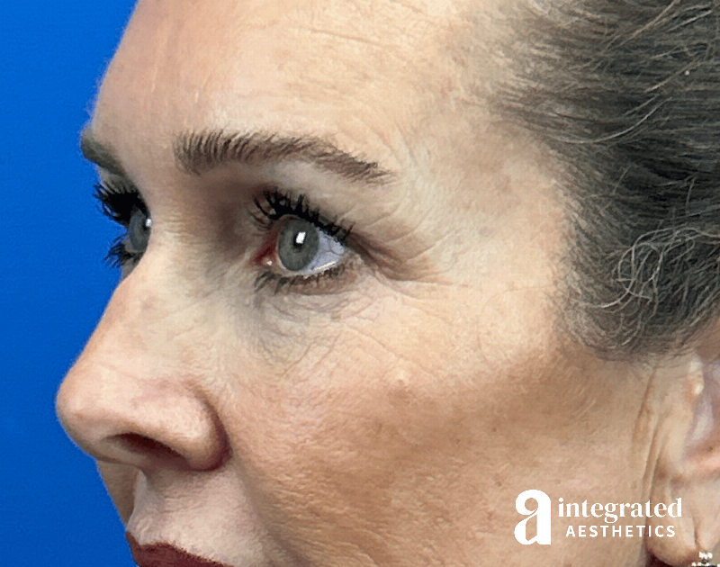 Blepharoplasty Before & After Gallery - Patient 301217 - Image 3