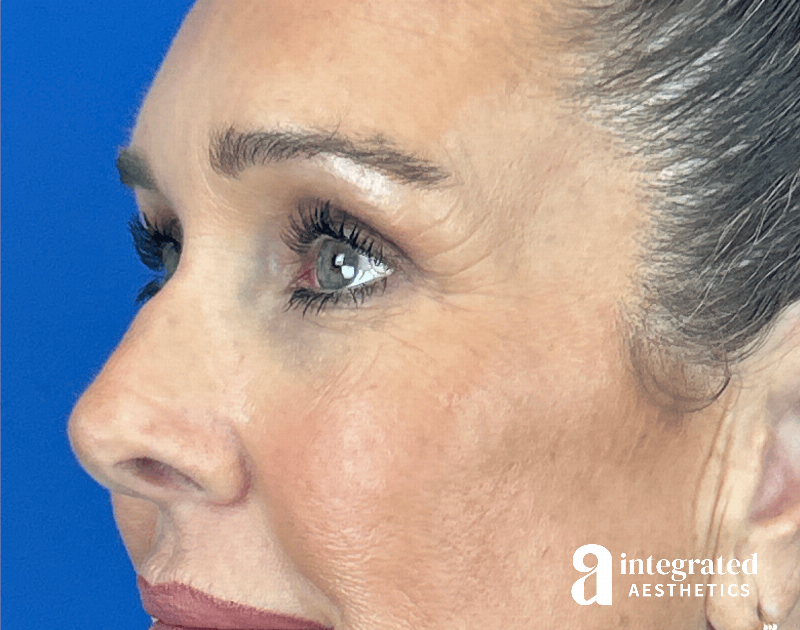 Blepharoplasty Before & After Gallery - Patient 301217 - Image 4