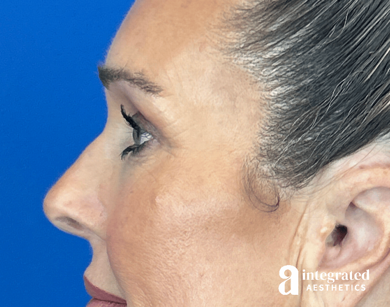 Blepharoplasty Before & After Gallery - Patient 301217 - Image 8