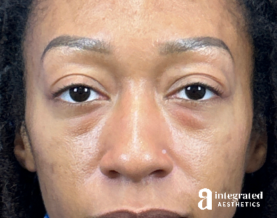 Blepharoplasty Before & After Gallery - Patient 247049 - Image 1