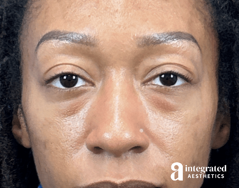 Blepharoplasty Before & After Gallery - Patient 247049 - Image 1