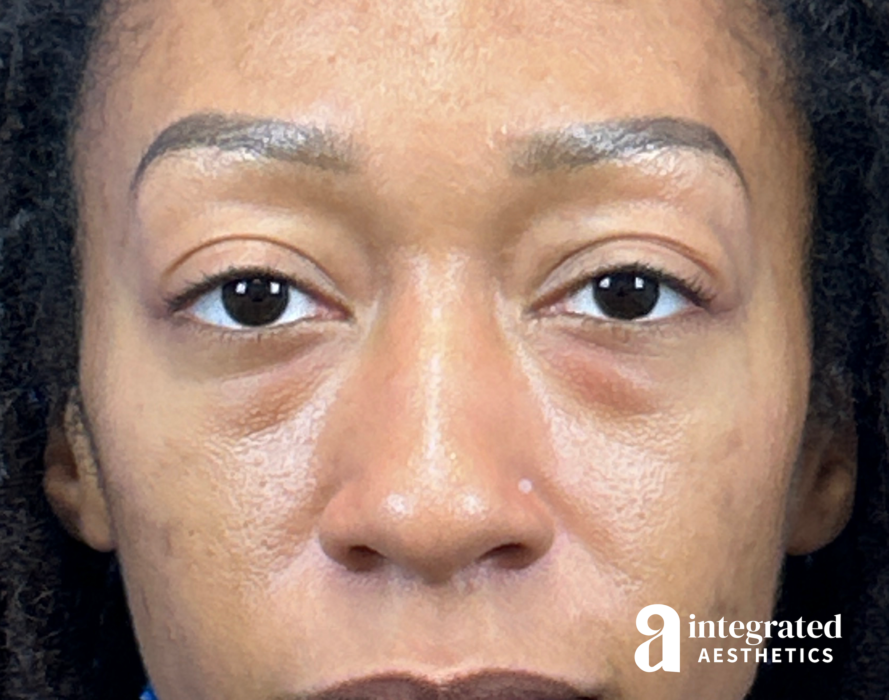 Blepharoplasty Before & After Gallery - Patient 247049 - Image 1