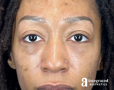 Blepharoplasty Before & After Gallery - Patient 247049 - Image 2