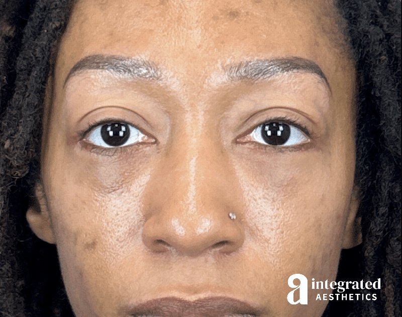 Blepharoplasty Before & After Gallery - Patient 247049 - Image 2