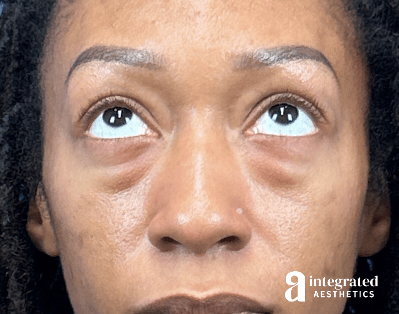 Blepharoplasty Before & After Gallery - Patient 247049 - Image 3