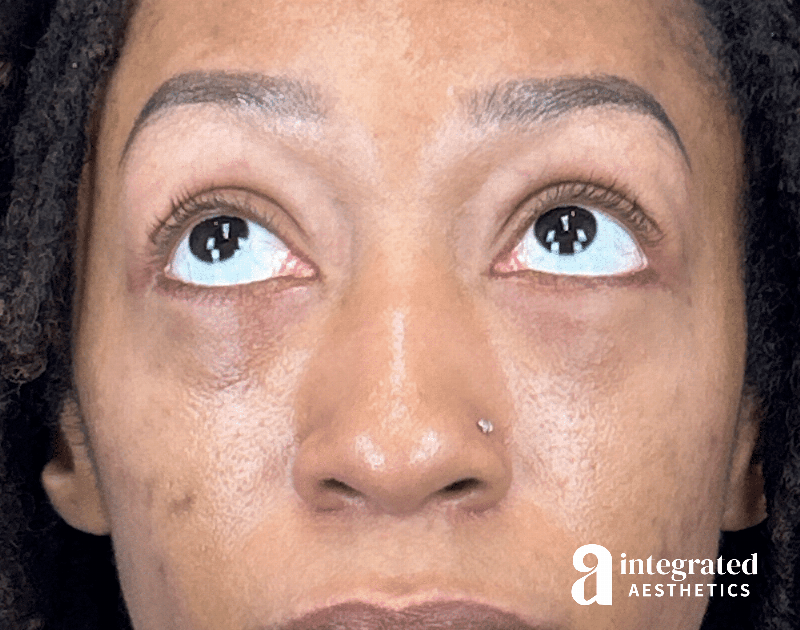 Blepharoplasty Before & After Gallery - Patient 247049 - Image 4