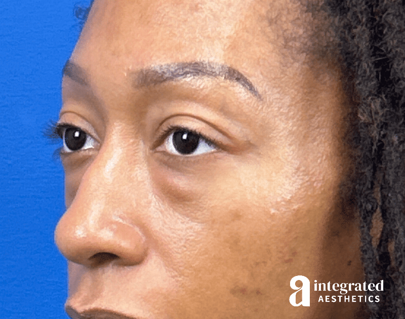 Blepharoplasty Before & After Gallery - Patient 247049 - Image 5