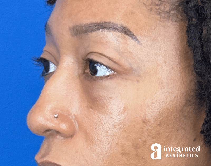 Blepharoplasty Before & After Gallery - Patient 247049 - Image 6