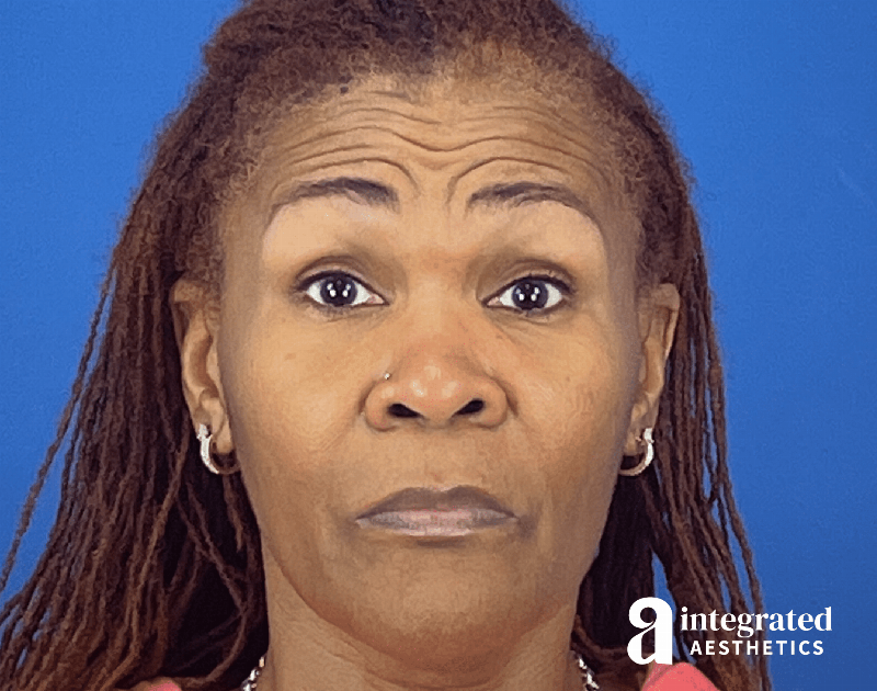 Wrinkle Relaxers Before & After Gallery - Patient 410539 - Image 1