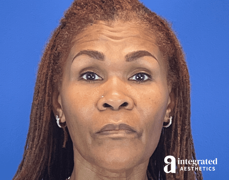 Wrinkle Relaxers Before & After Gallery - Patient 410539 - Image 2