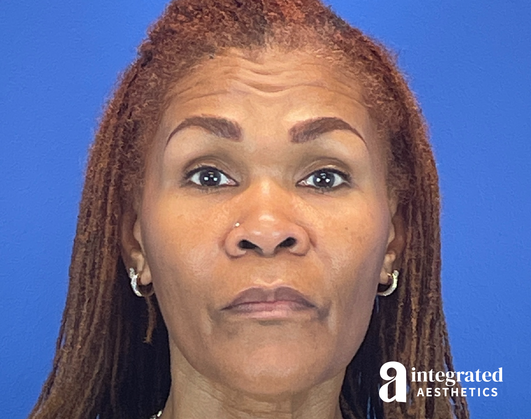 Wrinkle Relaxers Before & After Gallery - Patient 410539 - Image 2