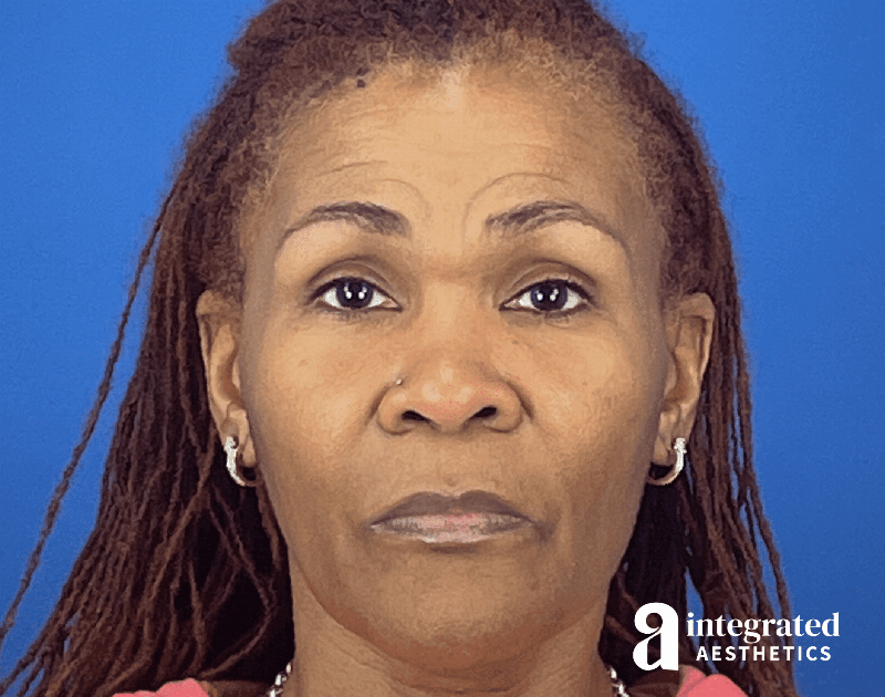 Wrinkle Relaxers Before & After Gallery - Patient 410539 - Image 3