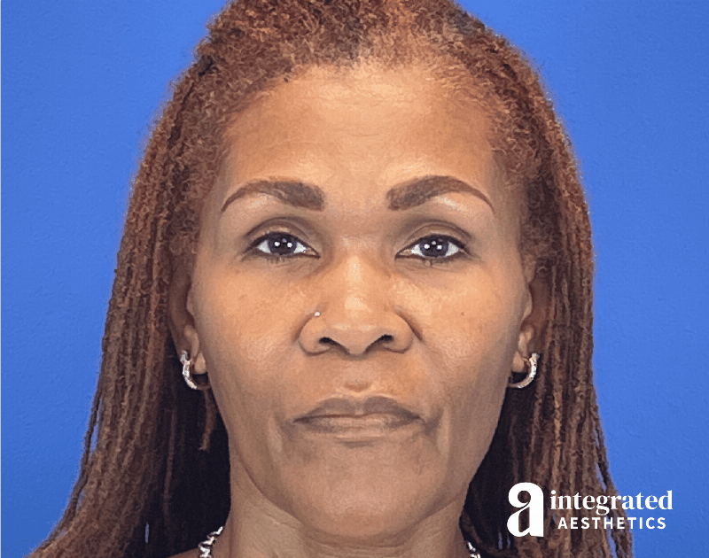 Wrinkle Relaxers Before & After Gallery - Patient 410539 - Image 4