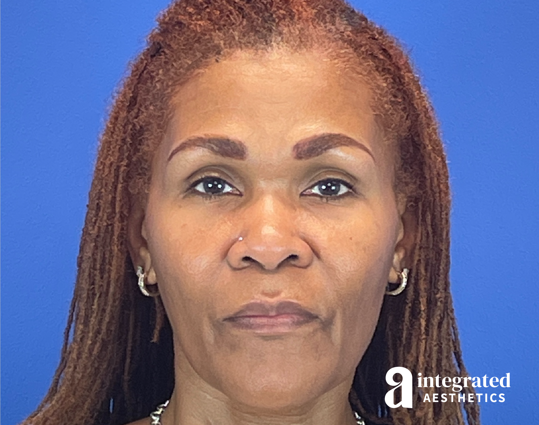 Wrinkle Relaxers Before & After Gallery - Patient 410539 - Image 4