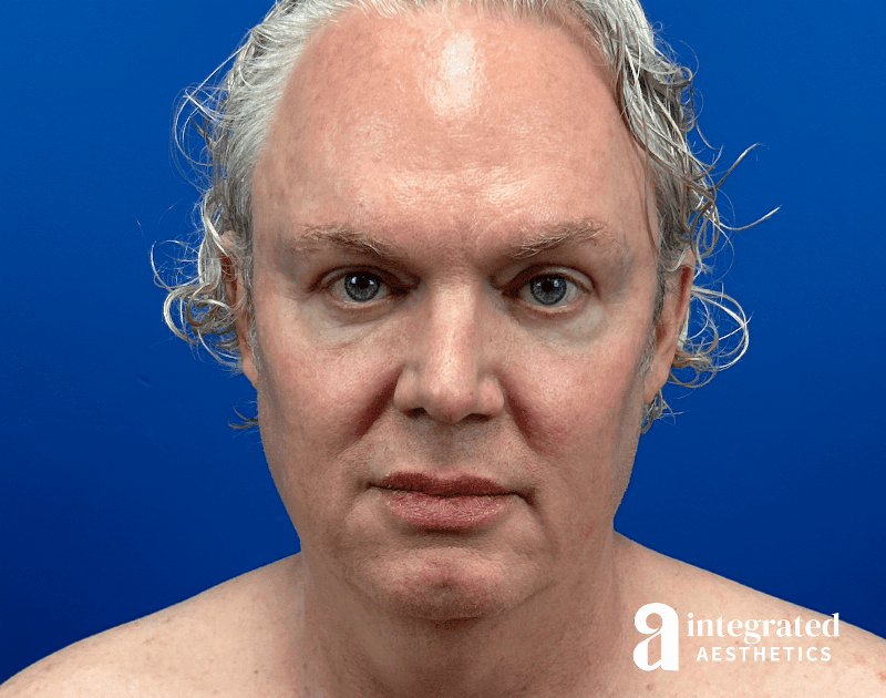 Facelift & Neck Lift Before & After Gallery - Patient 313601 - Image 1