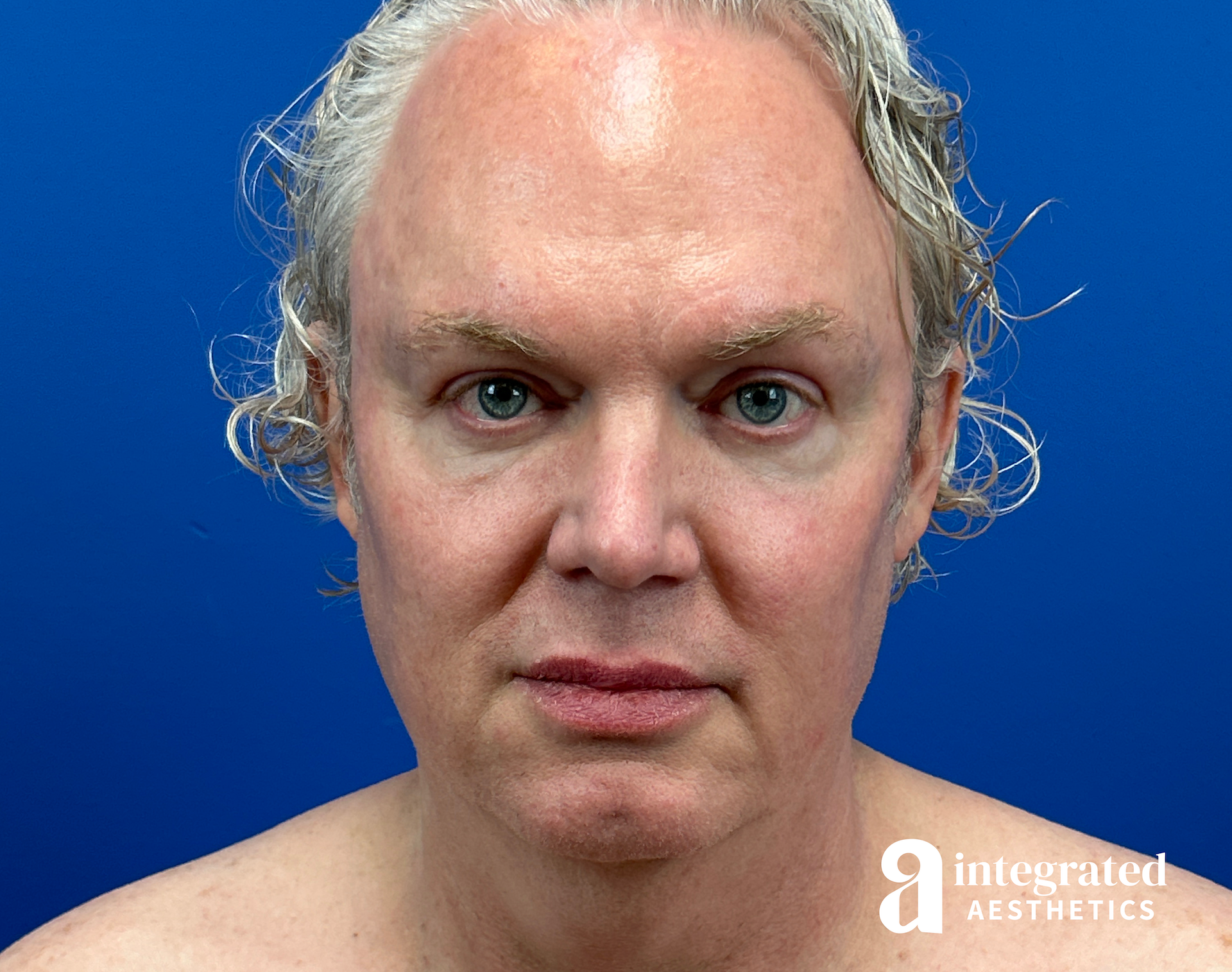 Facelift & Neck Lift Before & After Gallery - Patient 313601 - Image 1