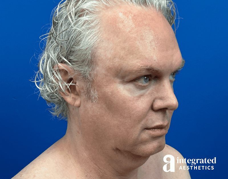 Facelift & Neck Lift Before & After Gallery - Patient 313601 - Image 3